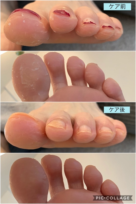 症例のご紹介 取手市 守谷市でフットケア 巻き爪ケアするならあしねっこ
