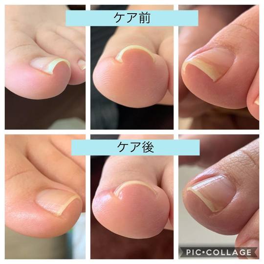 症例のご紹介 取手市 守谷市でフットケア 巻き爪ケアするならあしねっこ 症例のご紹介 取手市 守谷市でフットケア 巻き爪ケアするならあしねっこ
