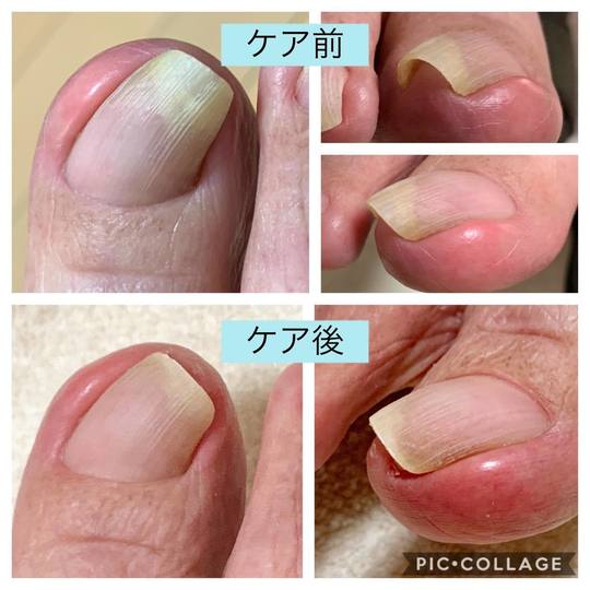 症例のご紹介 取手市 守谷市でフットケア 巻き爪ケアするならあしねっこ 症例のご紹介 取手市 守谷市でフットケア 巻き爪ケアするならあしねっこ